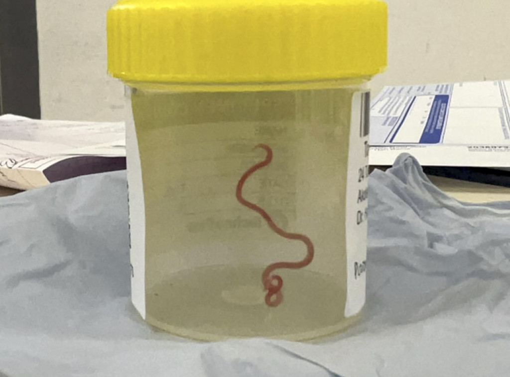 Lekari u mozgu Australijanke pronašli živog crva od osam centimetara