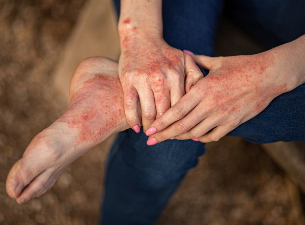 Udruženje 3P organizuje aktivnosti povodom obeležavanja Evropske nedelje psoriaze