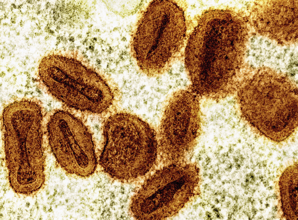 U Nemačkoj četiri člana jedne porodice zaražena novim sojem majmunskih boginja