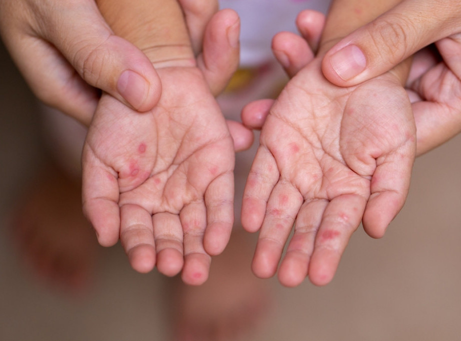 Batut: Od početka godine u Srbiji registrovano 197 slučajva malih boginja