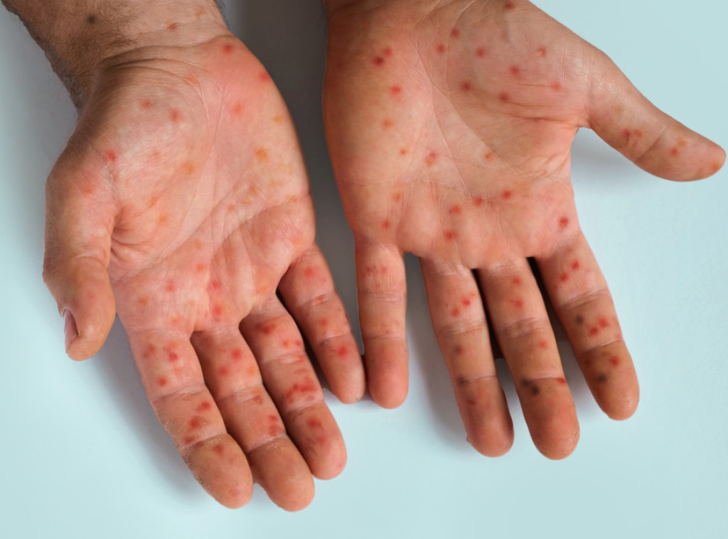 Etiopija prijavila prvi slučaj majmunskih boginja