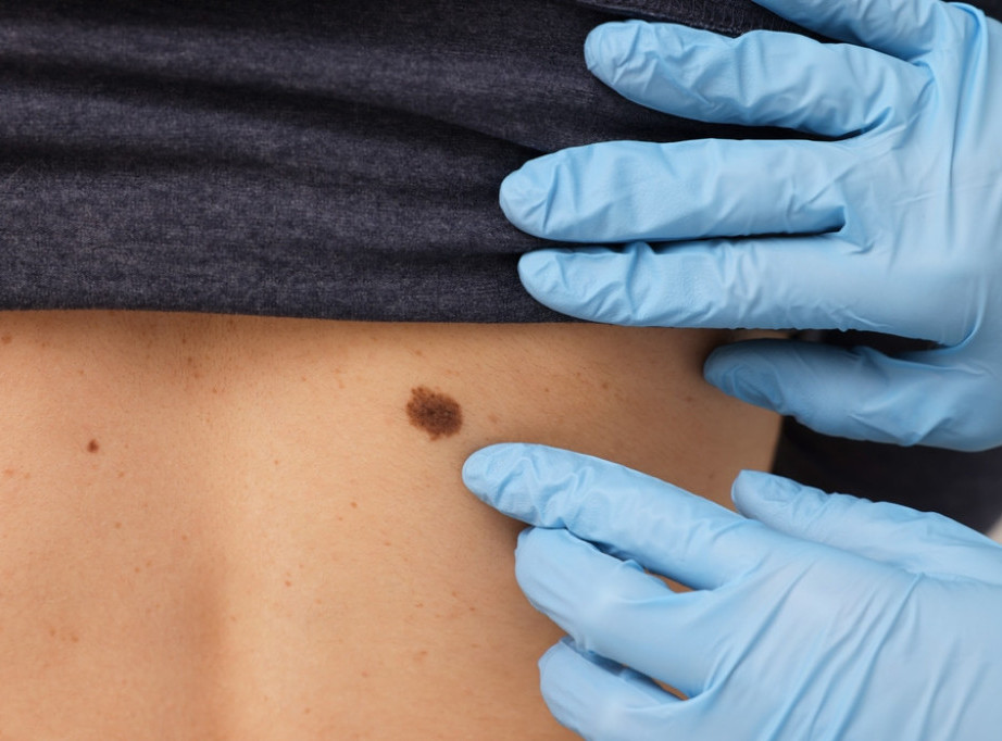 CIM: Kuba razvila lek protiv melanoma uprkos teškim energetskim i ekonomskim uslovima