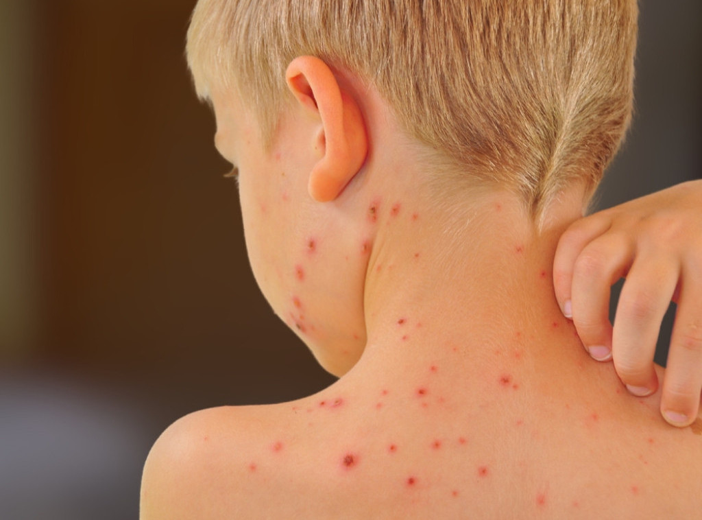 Izbila epidemija malih boginja u severnom Londonu, zaraženo više od 60 dece