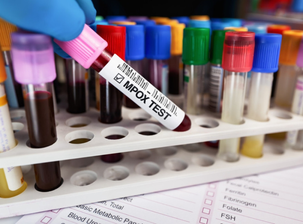 Ruski akademik: Virus majmunskih boginja mutira, stvaranje vakcine je neophodno