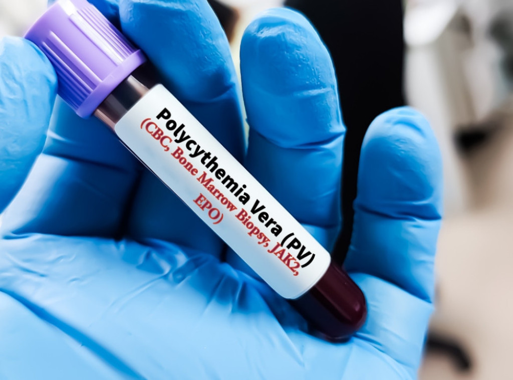 Retku bolest koštane srži policitemiju veru u Srbiji godišnje dobije 100 osoba