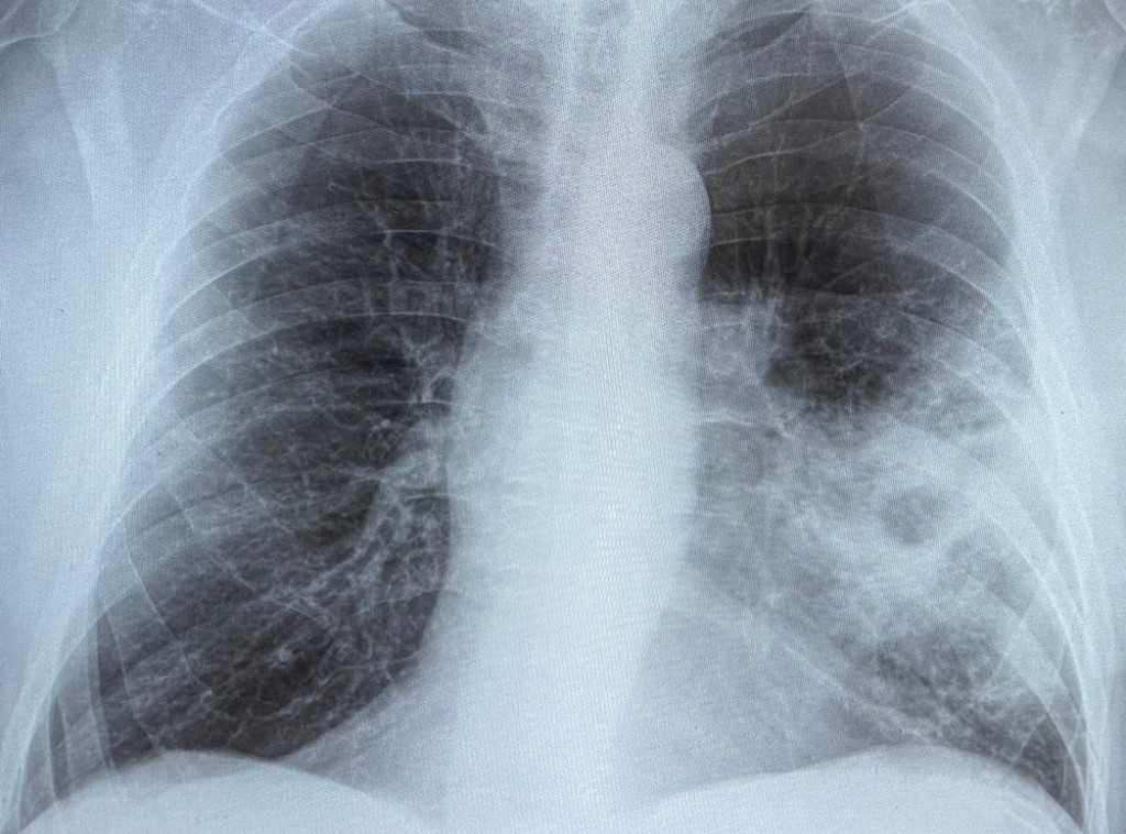 Više od pola miliona slučajeva upale pluća zahtevalo hitnu bolničku pomoć u Engleskoj