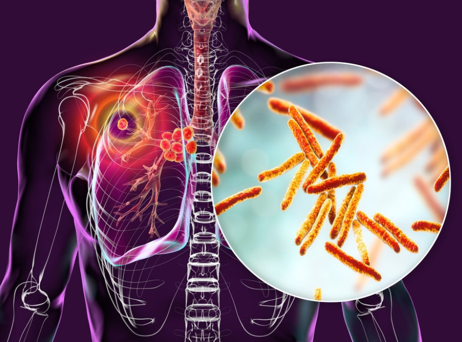 Danas se obeležava Svetski dan borbe protiv tuberkuloze